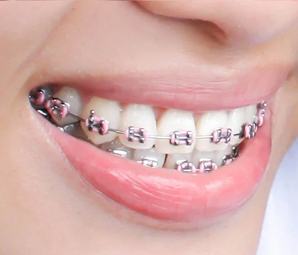 Braces